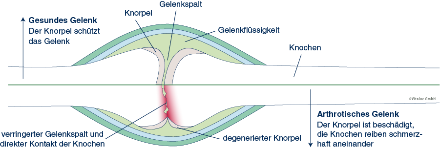 Arthrotisches Gelenk